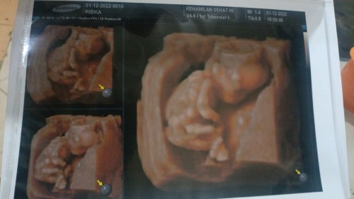 USG 13 weeks dede uby