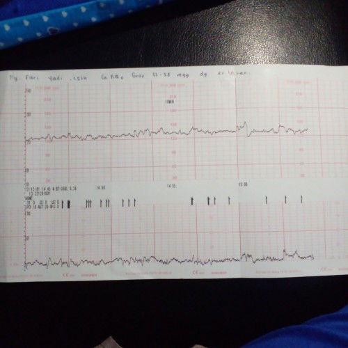 2x lilitan apa bisa lahiran normal