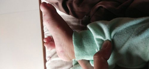 cara ngilangin bekas gigitan nyamuk