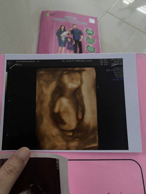 Hamil tapi ada miom nya