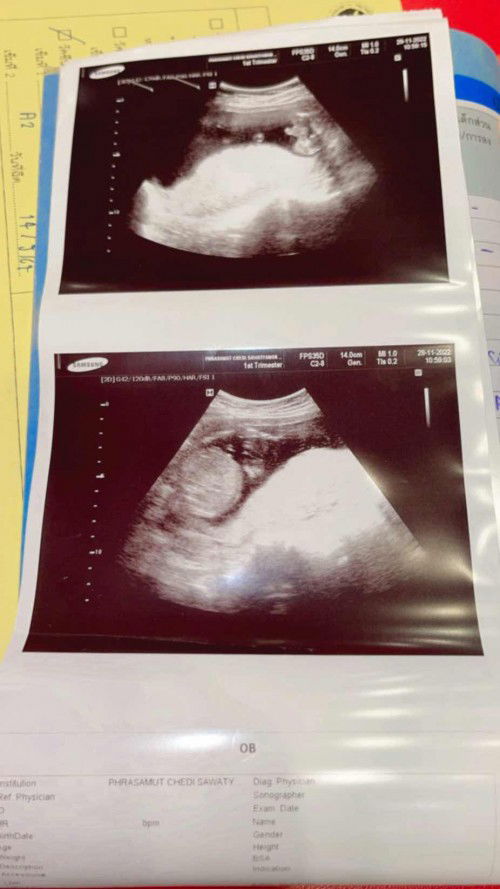 ช่วยดูเพศหน่อยได้ไหมค่ะ หมอบอกน้องมีจู๋ แต่ที่แม่เห็นมันเหมือนขามากเลยค่ะ