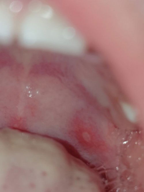 Ano po bang mga gamot ang mabisa para sa singaw