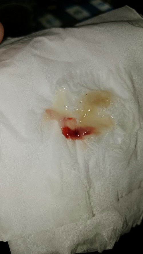 Kontraksi belum intens, masih bukaan 1