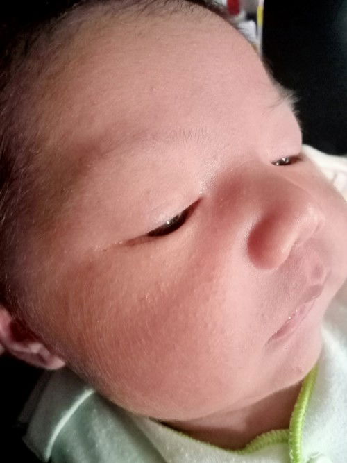 Kulit bayi bruntusan