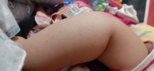 Bunda mau tanya , kenapa tangan anak saya kayak jadi beruntusan gini ya ?? Tolong sarannya bunda 🙏