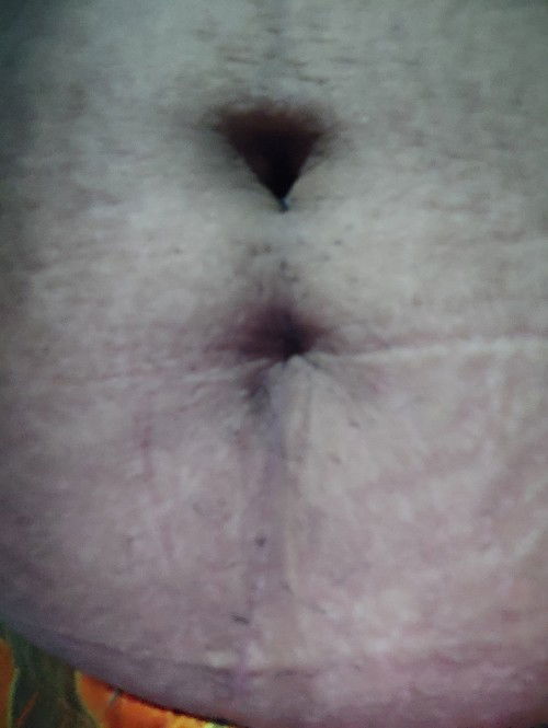 Tahi ng Cesarean delivery