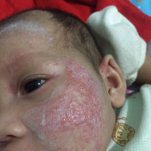 ผื่นแดงที่หน้าลูก