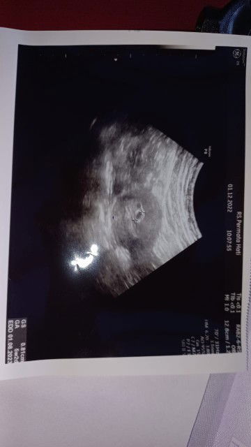 Ukuran GS 5 week 2 day 0,81cm atau 8,1mm. Normal bun? Dari hpht pas 5 weeks. Tp dari USG 5 wk 2 day?