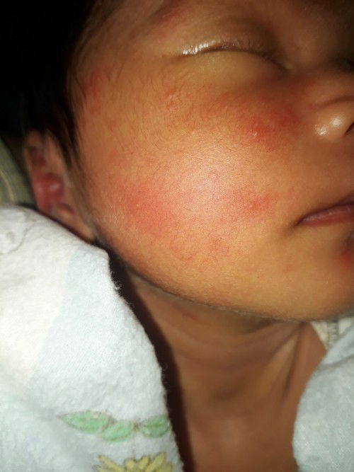 Bintik2 d wajah bayi 1 minggu