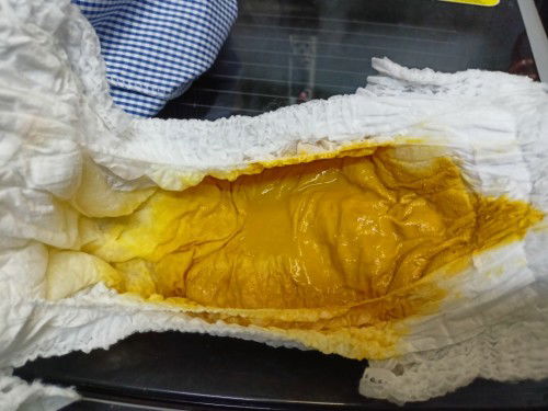 เปลี่ยนนมจากเอส26ม่วงมาเป็นเนตเล่เบบี ลูกท้องเสีย