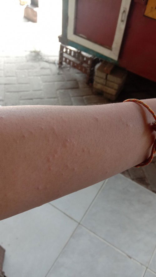 Gatal bruntusan obatnya apa ya