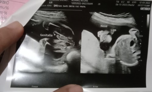 24weeks & 3days..