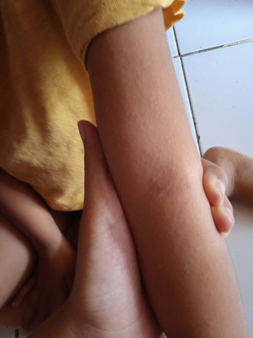 Beruntusan pada anak 5 tahun