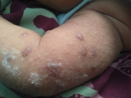 gatal gatal scabies bayi umur satu setengah bulan