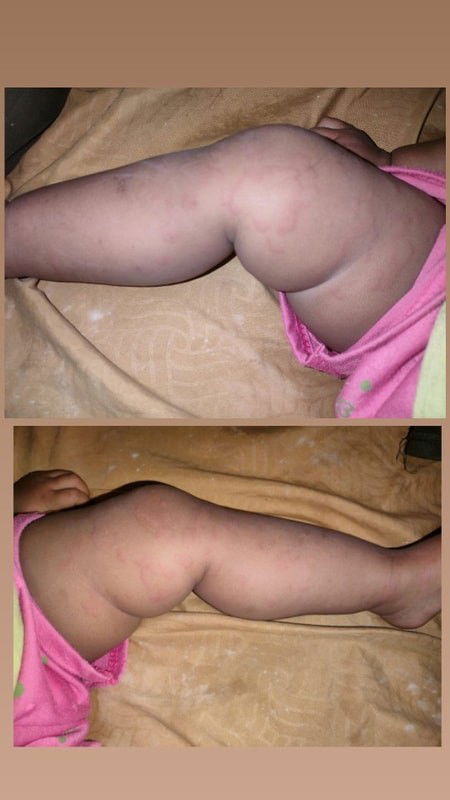 Campak/Biduran/Alergi?