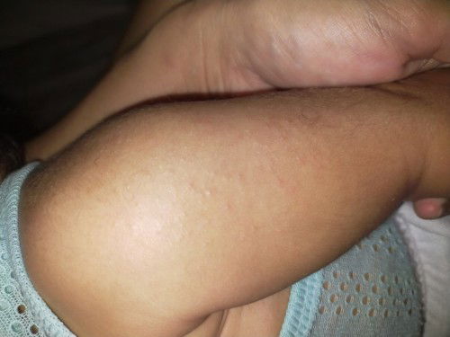 Butlig sa braso ni baby ano po kaya to? Meron din sa face at sa legs. Anonpo pwede gawin?