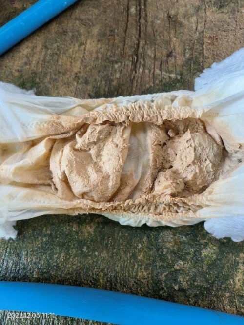 ลูกอึเป็นสีเหลืองอ่อนแบบนี้ผิดปกติมั้ยค่ะ ?