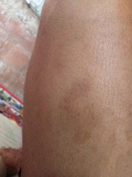 Muncul lebam tanpa sebab