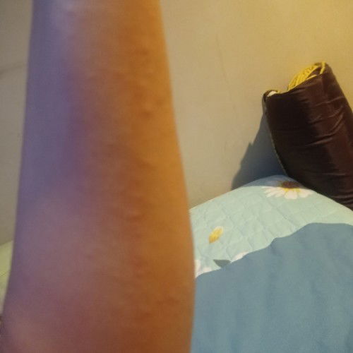 Adakah ibu2 yang pernah mengalami gatal2 seperti ini?