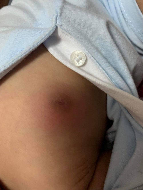 หัวนมลูกบวมแดงเกิดจากอะไร