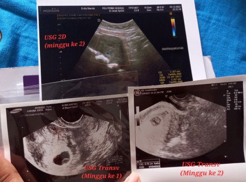 Flek Divonis Janin tidak berkembang