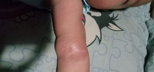 Kulit wajah dan lipatan tangan bayi yang kering, kasar, dan gatal. (Slalu digaruk).