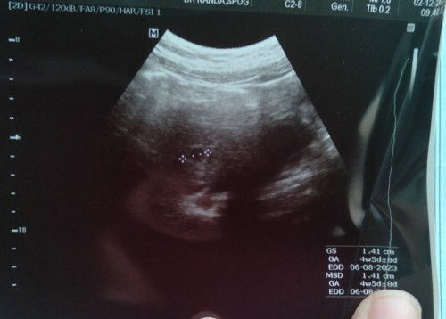 Kantung kehamilan kecil