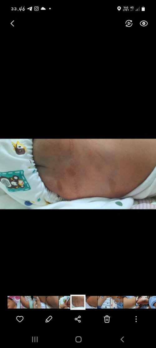 Bercak coklat pada bayi