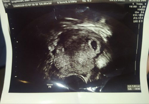 Usg 5week apakah normal