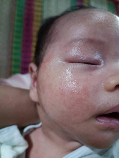 Các mom có cách nào chữa mụn như này ko ạ.e tắm khổ qua, bôi kem kutieskin mãi mà ko đỡ.bé bị 1m r ạ