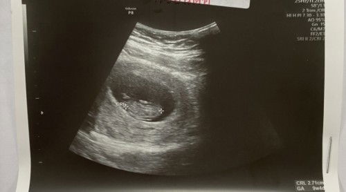 แม่ๆ ตั้งครรภ์ 9w-10w ไม่แพ้ท้องเลย ปกติมั้ยคะ