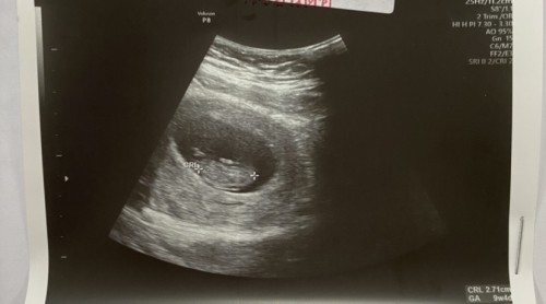 แม่ๆ ตั้งครรภ์ 9w-10w ไม่แพ้ท้องเลย ปกติมั้ยคะ