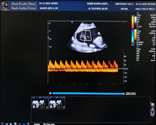 Usg 26week bjj brp bun?