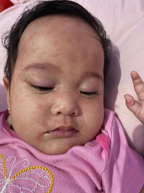 Bayi 8 bulan kena campak