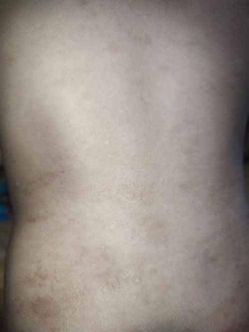 Allergy? Chicken Skin-like