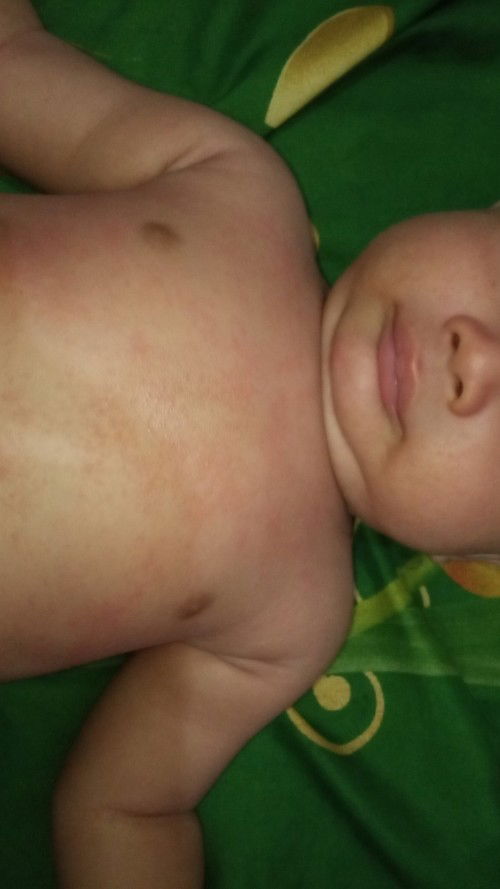 MASALAH KULIT BAYI😭😭🙏🙏