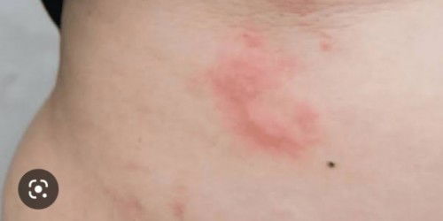 Perihal Gatal"kulit kaki dan tangan