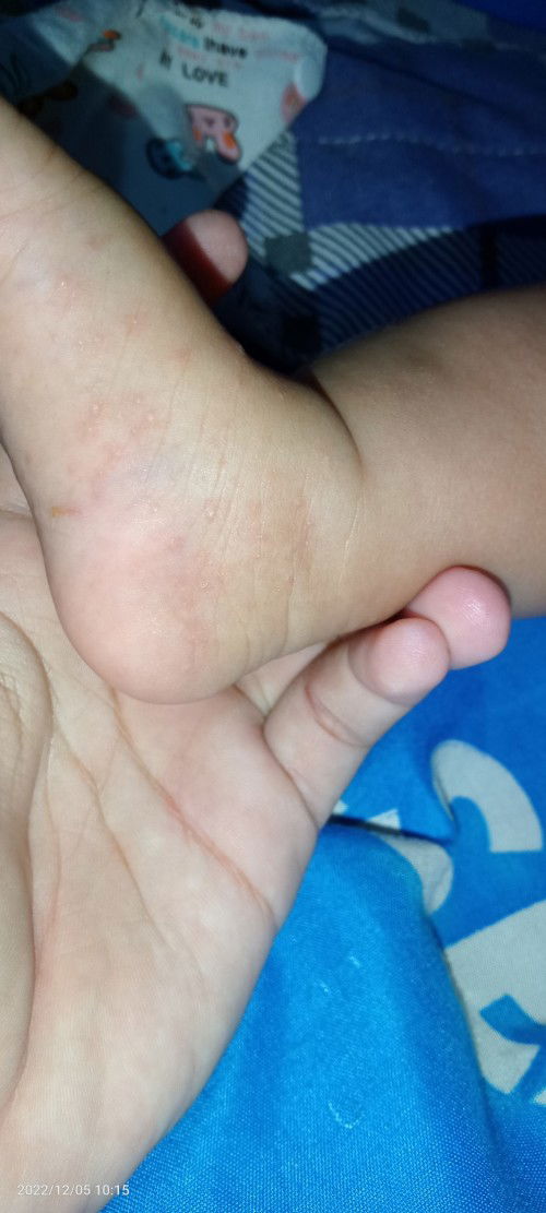 Kulit anak timbul bintik" merah berair