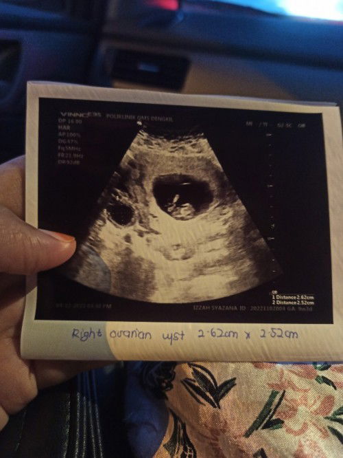 9 weeks scan ada cycs size 2 cm