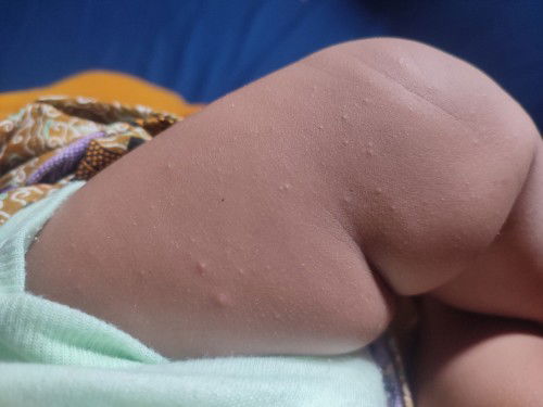 Bruntusan di kaki bayi