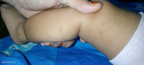 Timbul bintik" merah