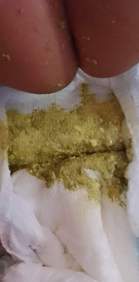 Yellow & Green Watery Poop 6 mos old baby