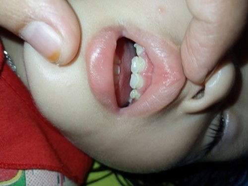 Karang gigi pada anak