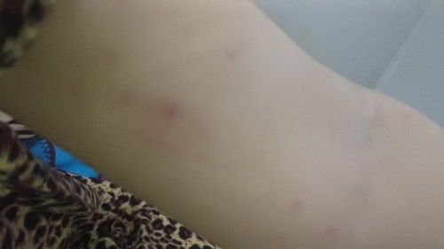 Hamil week 7. Gatal yg luar biasa di kaki, paha, tangan, punggung muncul bintik merah.Serta keputihn