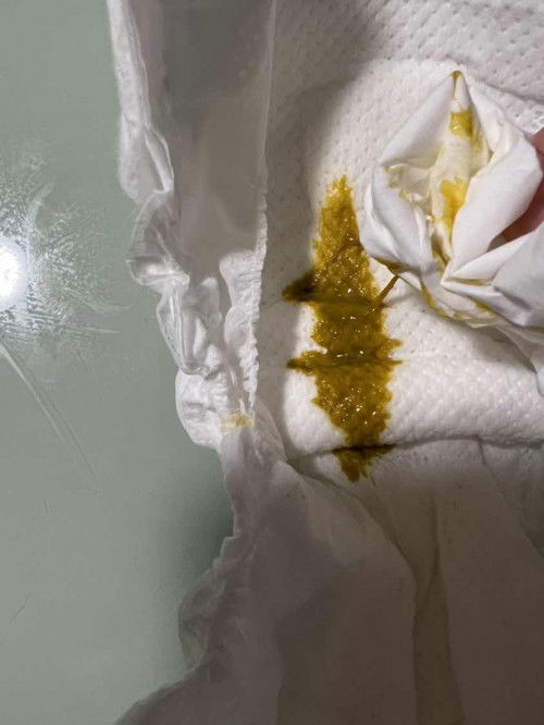 Is Jelly-like/sticky poop normal for fully breastfed 17wk old baby?