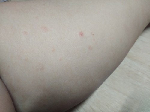 เป็นตุ่มแดงๆ คัน ตามแขน ขา ท้อง