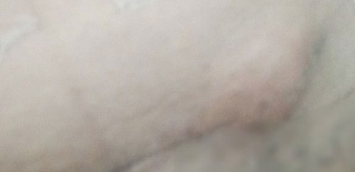 Bengkak pasca operasi Caesar