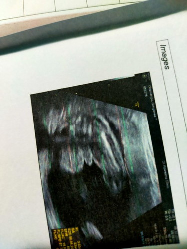 22w2Dน้ำหนักตัวน้องแม่ๆบ้านอื่นเท่าไหร่กันค่ะมาแชร์กันค่ะ