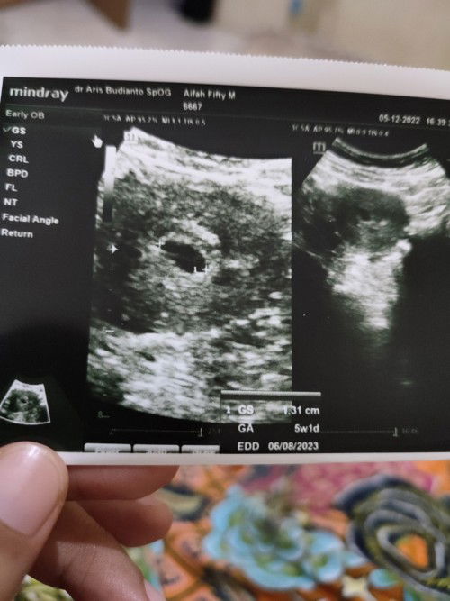 Perbedaan hpt dengan usg