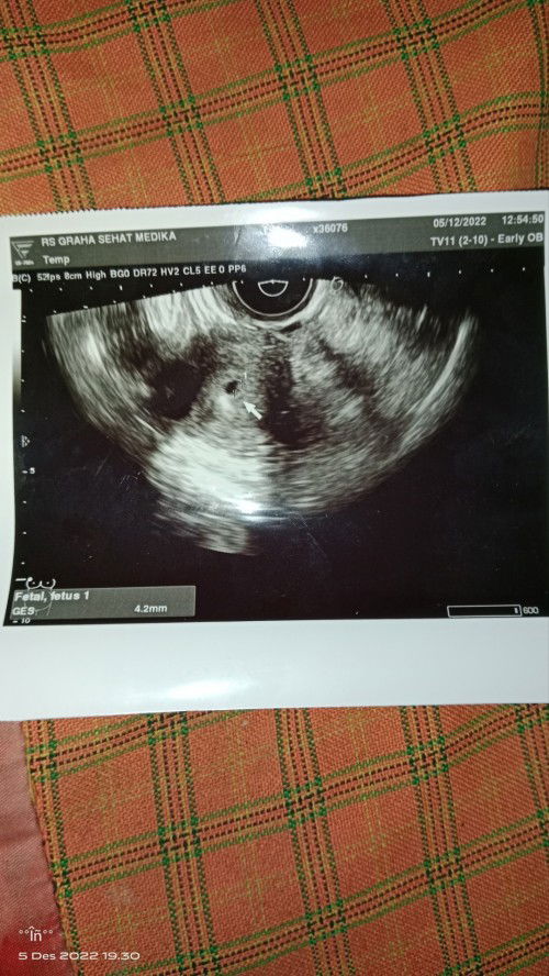 USG 3 weeks HPHT 2November